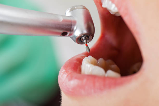 Best Emergency Wisdom Teeth Removal in Newcastle, OK